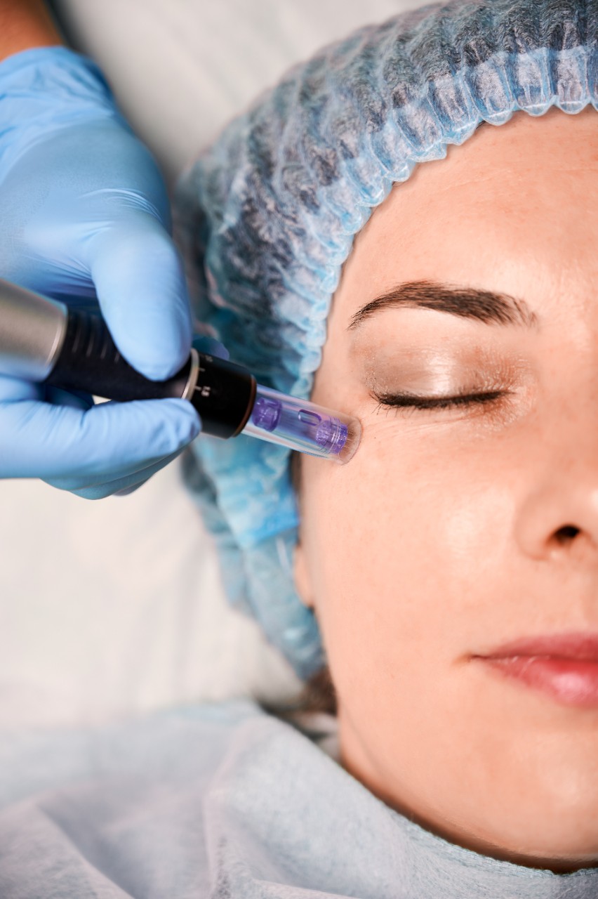 dermapen facial